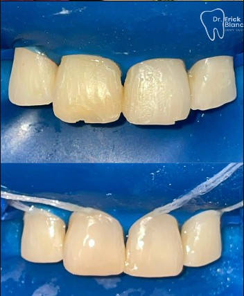 Fotografía clínica dental de seguimiento